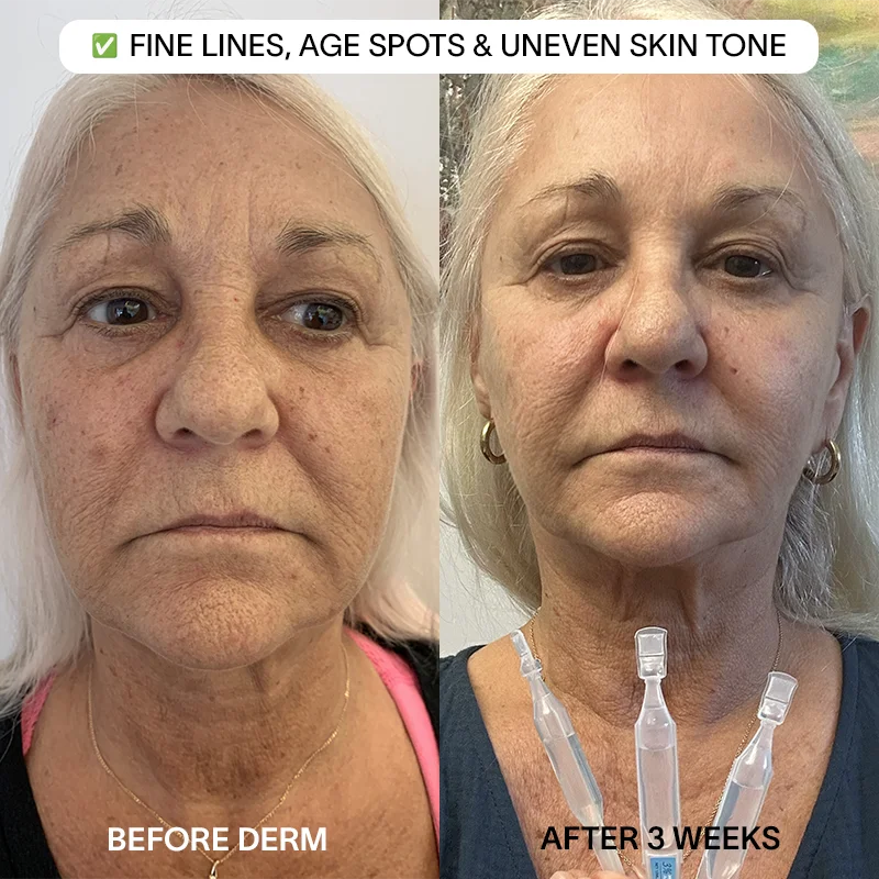 Derm™ 3% Hyaluronic Acid - Cyber Monday Sale