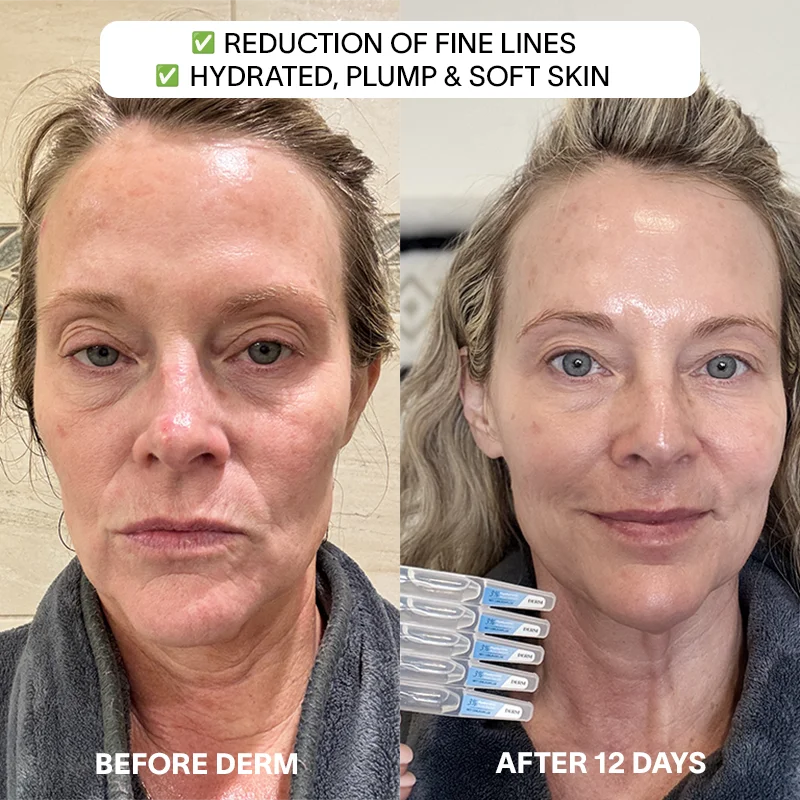 Derm™ 3% Hyaluronic Acid - Cyber Monday Sale