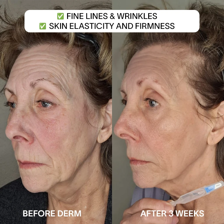 Derm™ 3% Hyaluronic Acid - Cyber Monday Sale