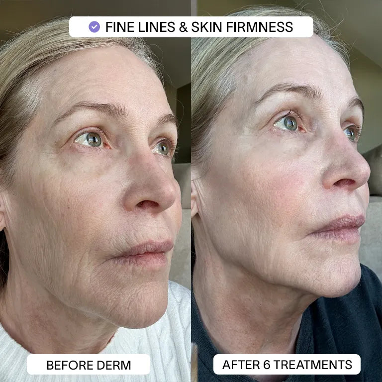 1x PDRN Micro Infusion Kit (2 treatments)