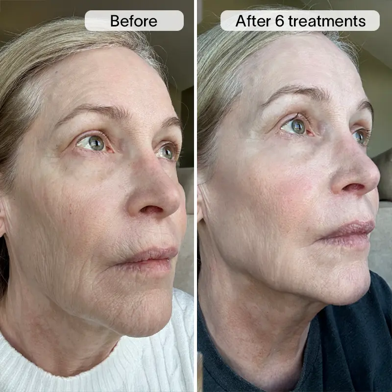 PDRN Micro Infusion Treatment