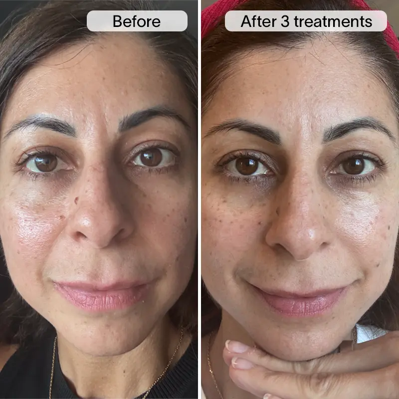 PDRN Micro Infusion Treatment