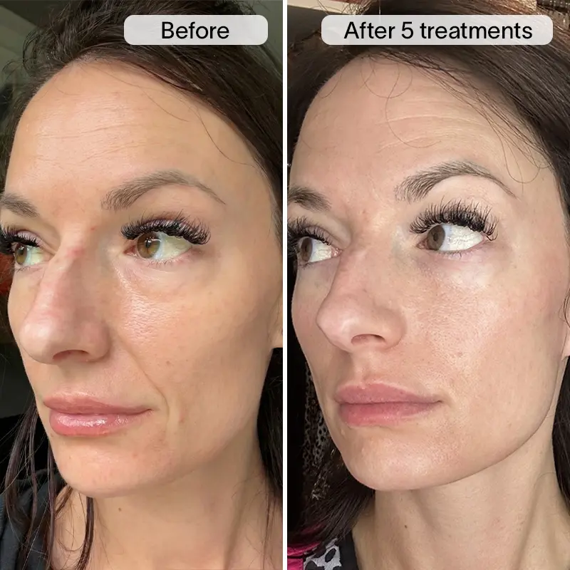 PDRN Micro Infusion Treatment