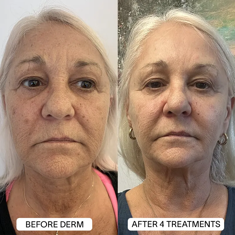 1x PDRN Micro Infusion Kit (2 treatments)