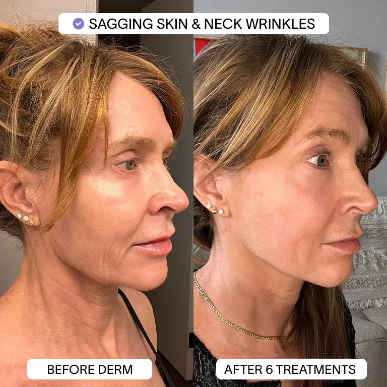 1x PDRN Micro Infusion Kit (2 treatments)