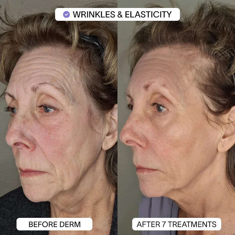 1x PDRN Micro Infusion Kit (2 treatments)