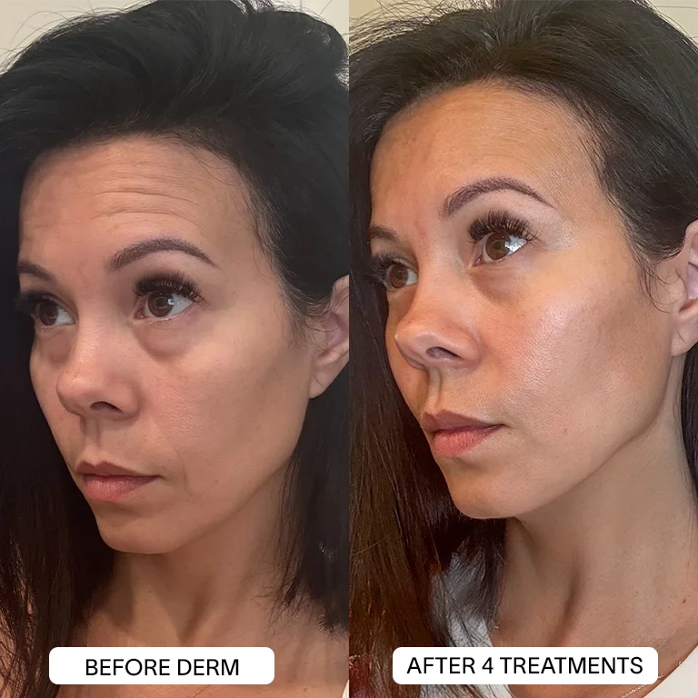 1x PDRN Micro Infusion Kit (2 treatments)