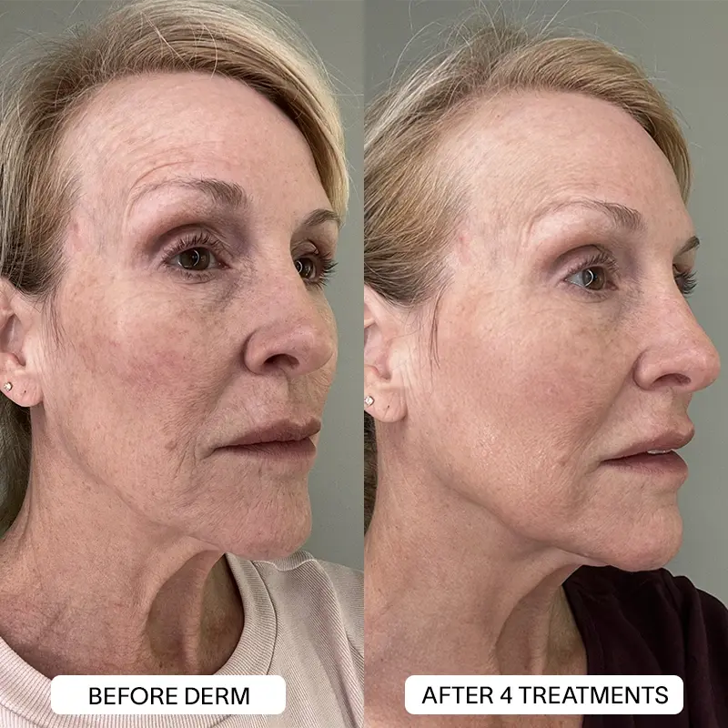 1x PDRN Micro Infusion Kit (2 treatments)